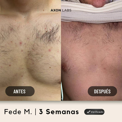 AXON – Tratamiento Corporal Antiacné